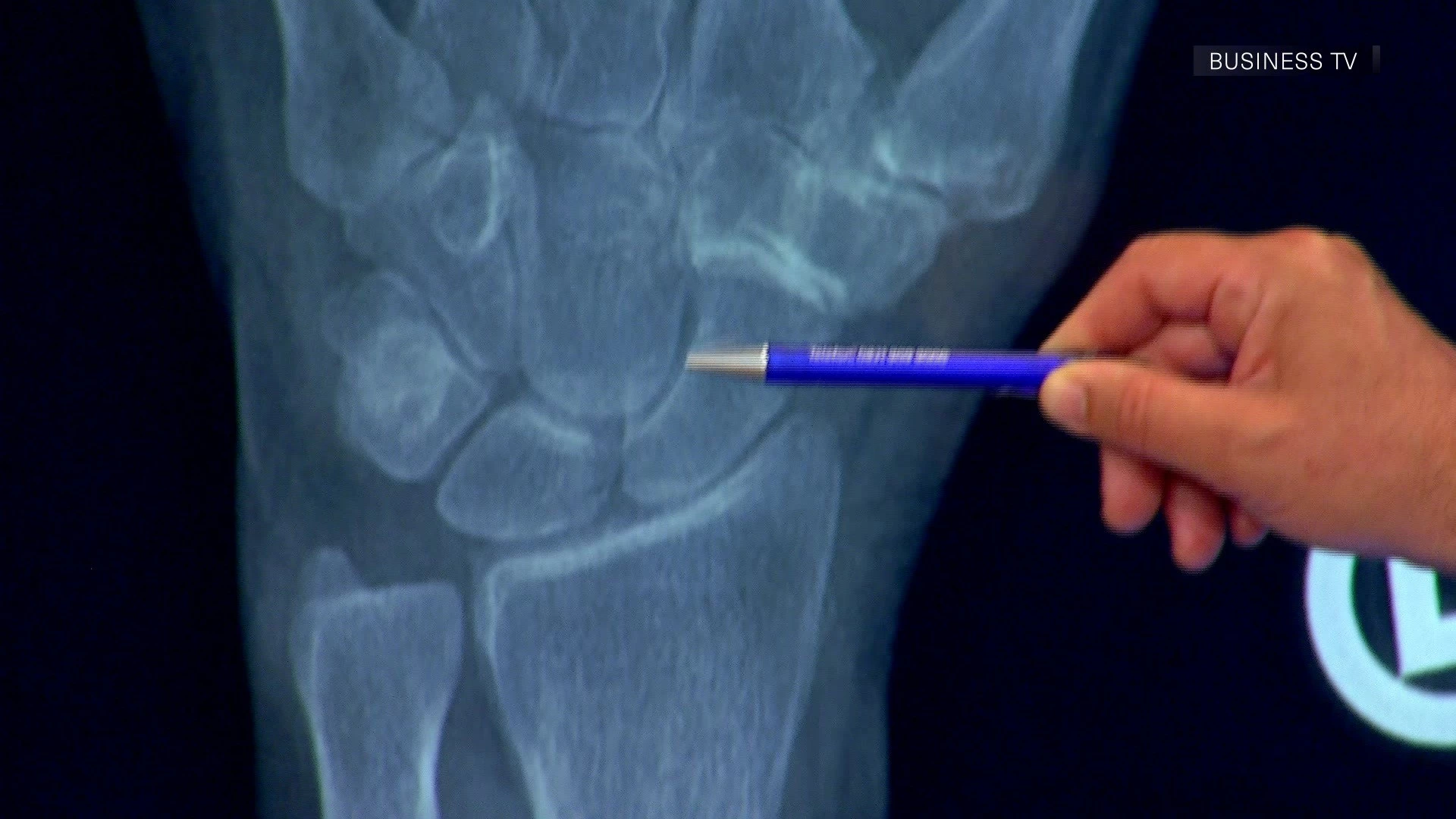 Gesundheit  Fingergelenkprothesen